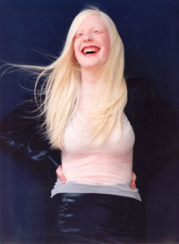 Young woman with albinism Young woman with albinism