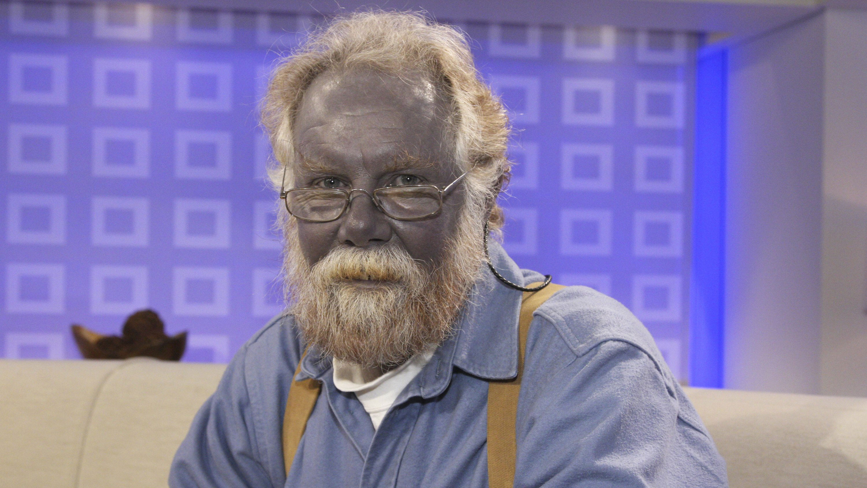 Argyria Argyria