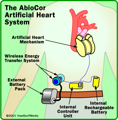 Diagram of the AbioCor heart