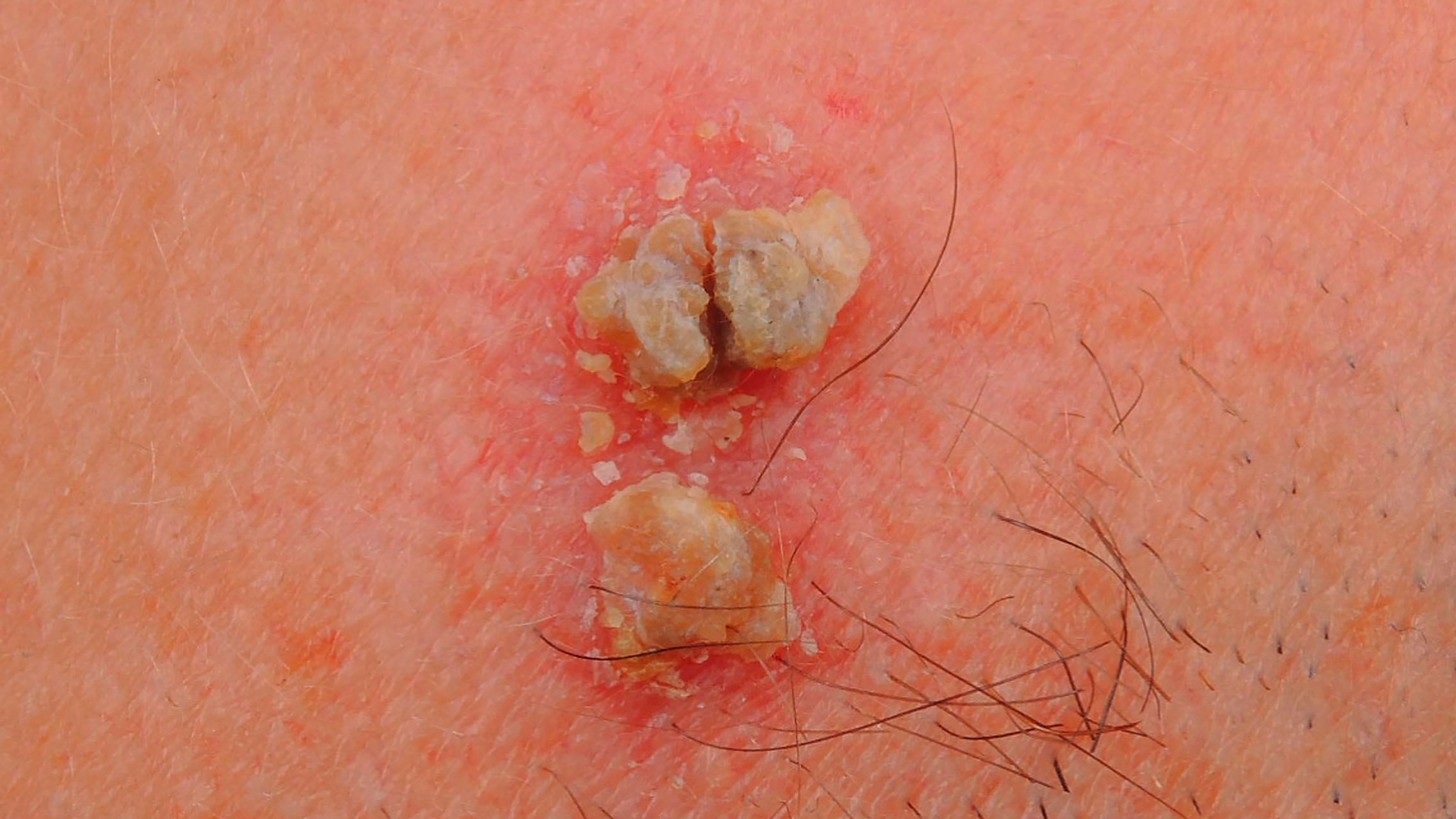 Bowen's Disease Bowen's Disease