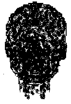 Normal cerebral blood flow study showing cranial space filled with blood