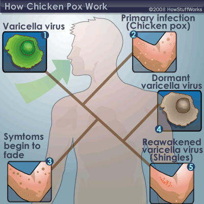 Chicken Pox Symptoms | HowStuffWorks