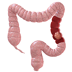 Colon Cancer Howstuffworks