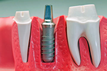 dental implant procedure procedures oral care health