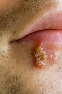 fever blisters on cheek