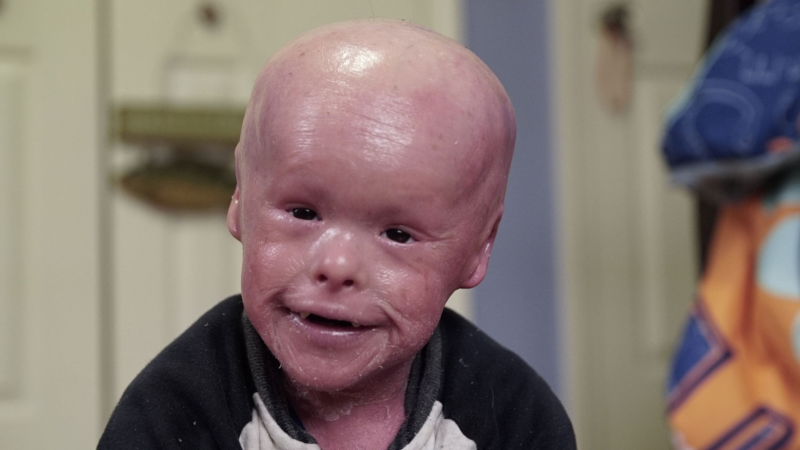 Harlequin Ichthyosis Harlequin Ichthyosis