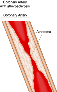 blocked artery