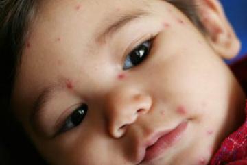 baby with chicken pox baby with chicken pox