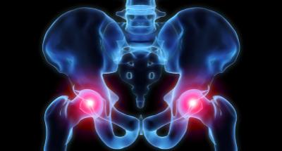 3-D rendering of inflamed hip