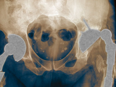 dislocated artificial hip X-ray