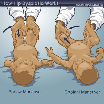 Barlow and Ortolani maneuver diagram