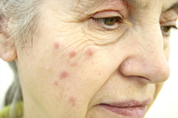 severe hives on face