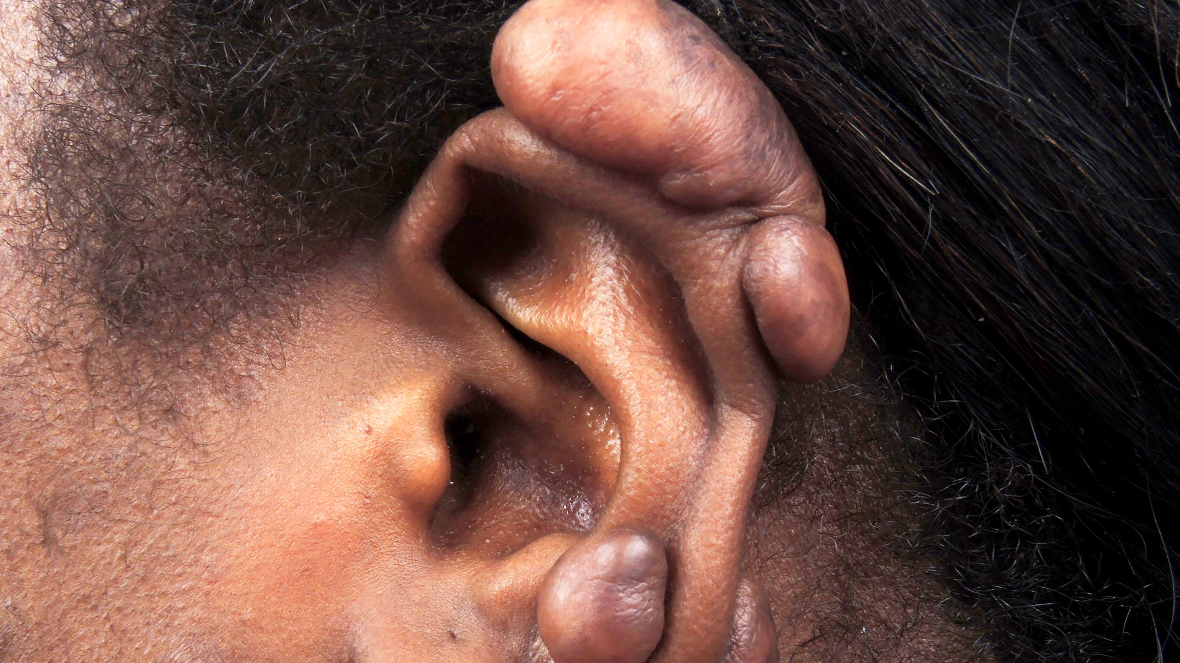 Keloid Keloid