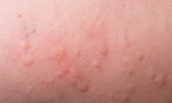 What are some common symptoms of a shellfish allergy? | HowStuffWorks