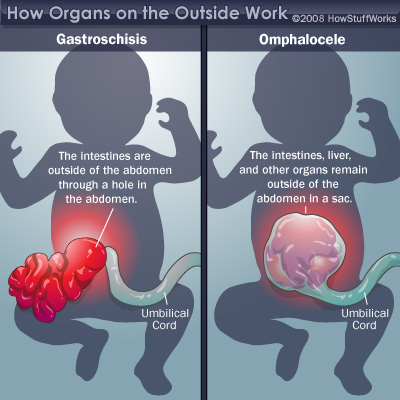How Can Someone Be Born With Organs Outside The Body Howstuffworks
