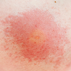 What Are Some Sulfur Allergy Symptoms Howstuffworks