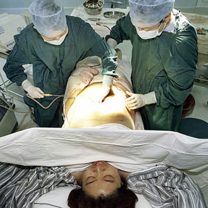 smart liposuction surgery