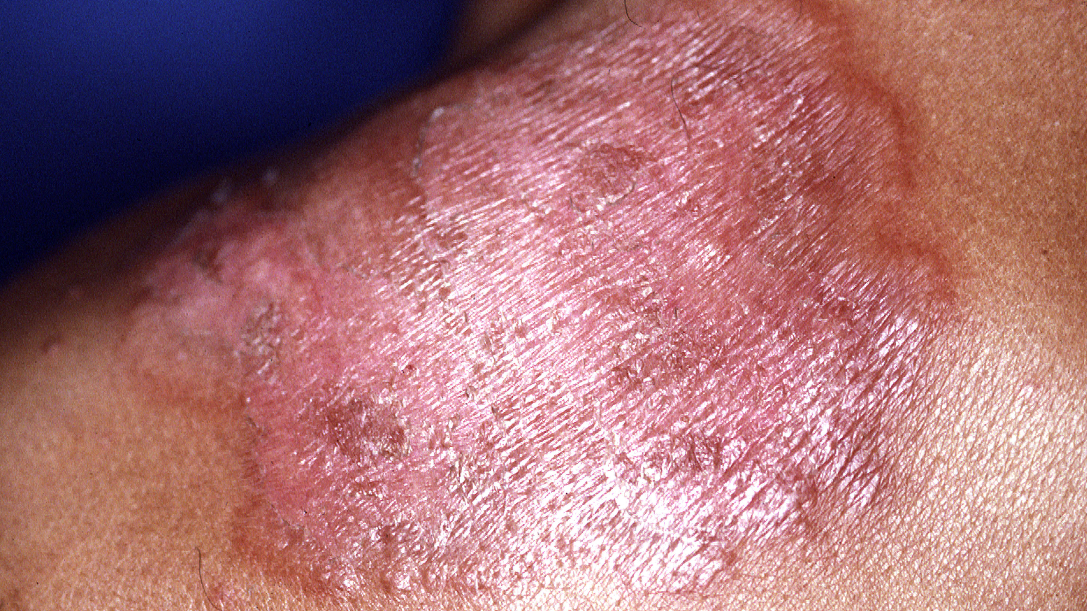 Skin Problems Image Gallery Howstuffworks