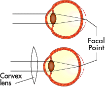 Figure 3: If you are farsighted, the image doesn't come into focus before it hits your retina (top). A convex lens can bring the focus forward (bottom).