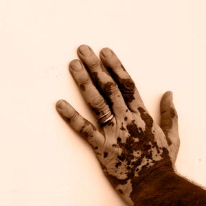 Man's hand affected by vitiligo, or depigmentation of skin. Man's hand affected by vitiligo, or depigmentation of skin.